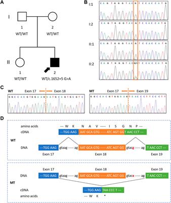 Case report: FOXP1 syndrome caused by a de novo splicing variant (c.1652+5 G>A) of the FOXP1 gene